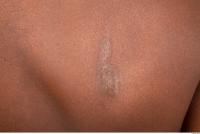 photo texture of scar skin